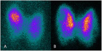 Anti-thyroglobulin Antibodies as a Possible Risk Factor for Graves' Disease After Radioiodine Treatment for Toxic Nodular Goiter: Case Report